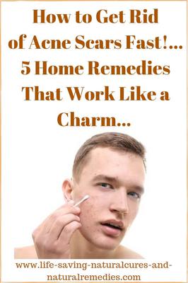 To scars remove remedies home quickly acne 24 Tips