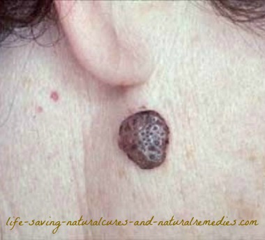 A Home Remedy for Seborrheic Keratosis That Works A Treat!