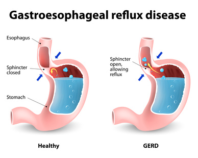 Best gerd reflux remedies
