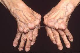 natural arthritis cure