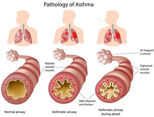 Asthma emergency relief remedies that work fast