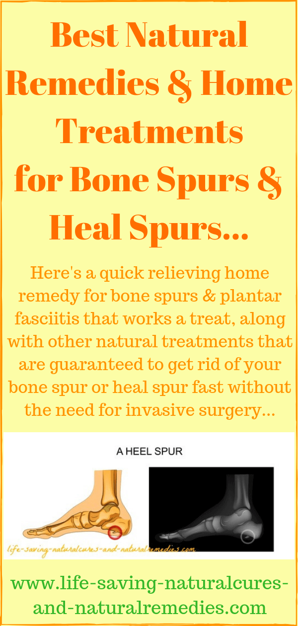 Bone spurs heal spurs home remedies