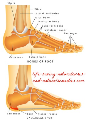 Natural remedies for bone spurs