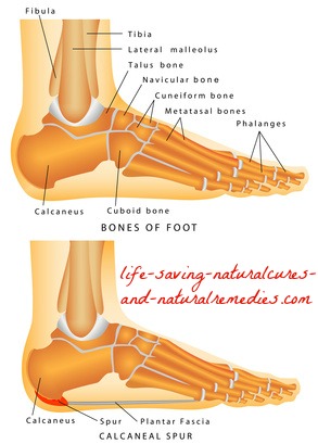 Best home remedies for dissolving bone spurs and heal spurs