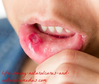 Best natural home remedies for canker sores mouth ulcers