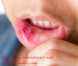 Best natural home remedies for canker sores mouth ulcers