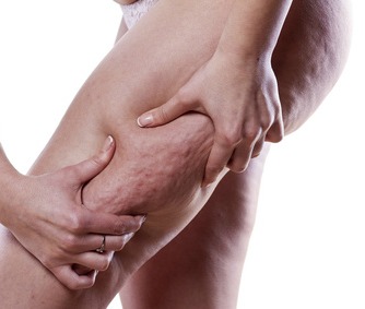 Best home remedies for quick cellulite removal