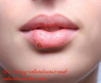 Best fever blister cold sore home remedies