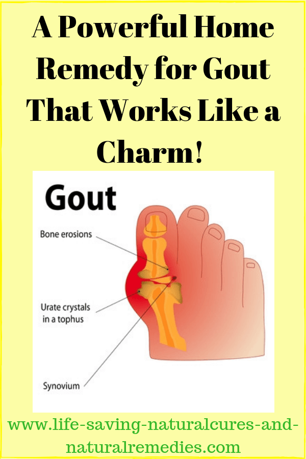 Gout Home Remedies Best