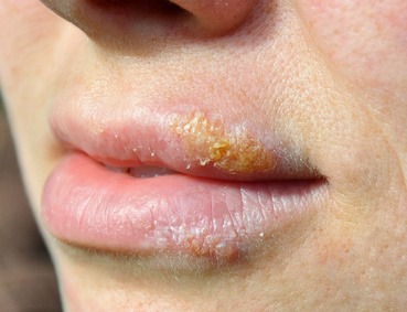 Natural herpes treatment for HSV1 and HSV2