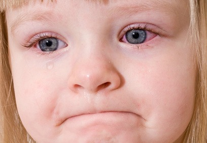 Best pink eye conjunctivitis remedies