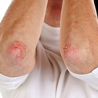 Natural Psoriasis Treatment