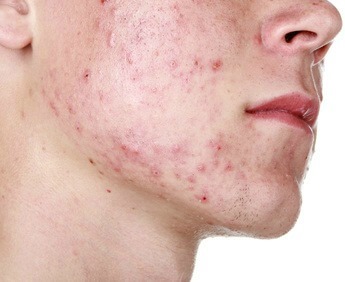 Best natural home remedies for acne and pimples