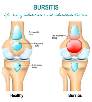 Best natural home remedies for bursitis