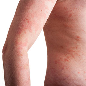 Foods for Treating Psoriasis and Eczema