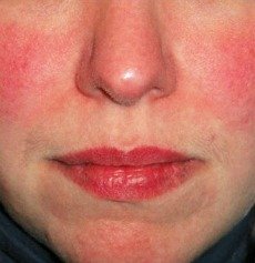 Rosacea natural remedies