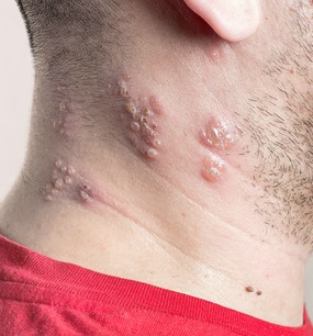 Best natural remedies for shingles